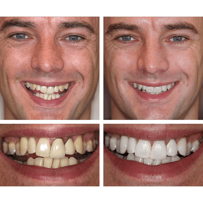 Oakly Teeth Whitening Solution