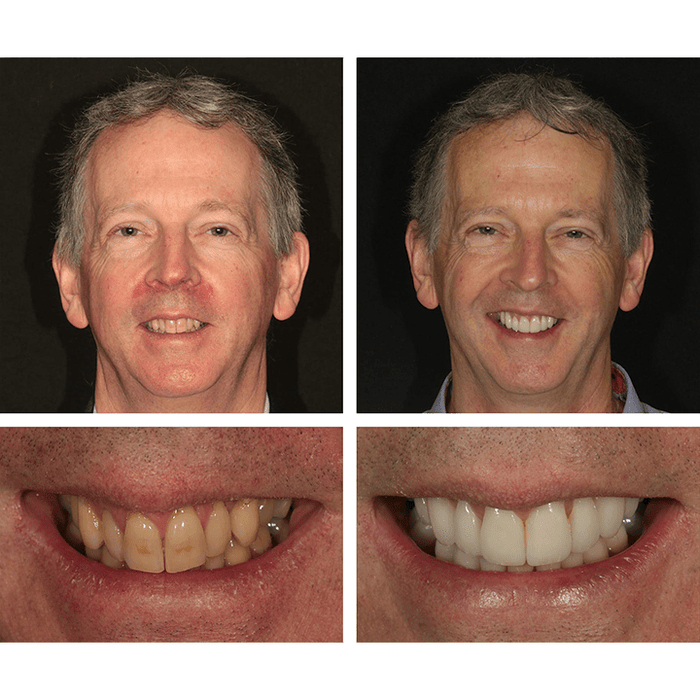 Oakly Teeth Whitening Solution