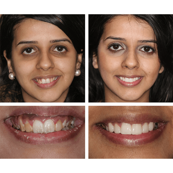 Oakly Teeth Whitening Solution