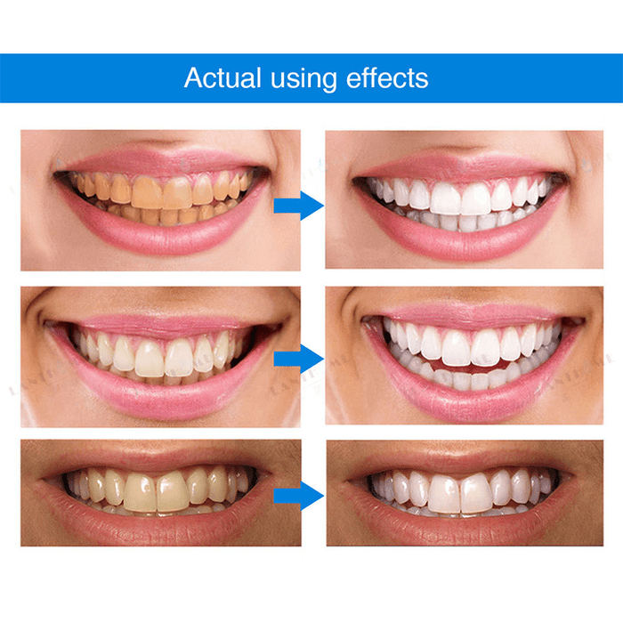 Oakly Teeth Whitening Solution